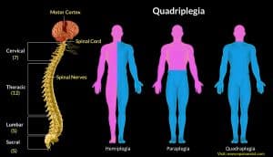 quadriplegia injury