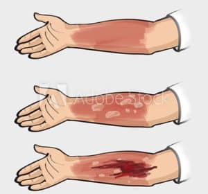 Types of Burn Injuries 