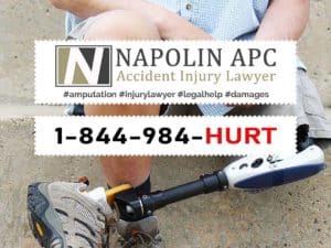 Napolin Amputation Injury Lawyer